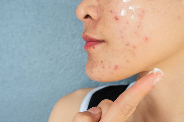 Diet plays an important role in naturopathic acne treatment.