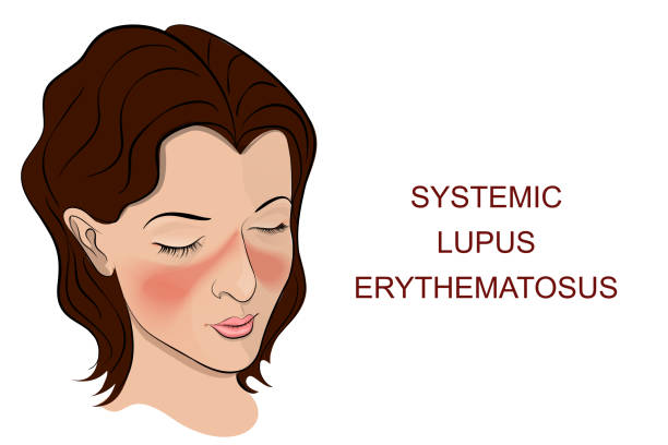 Lupus is a chronic autoimmune disease that affects the skin, joints, kidneys, and other organs. Its symptoms can vary greatly from person to person and fluctuate over time. Lupus disease's most common symptoms include joint pain, stiffness, edema, fatigue, fever, headaches, sores, rashes, hair loss, and anemia.