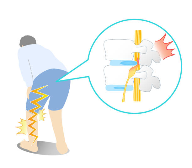 Common Triggers and Causes of Sciatica