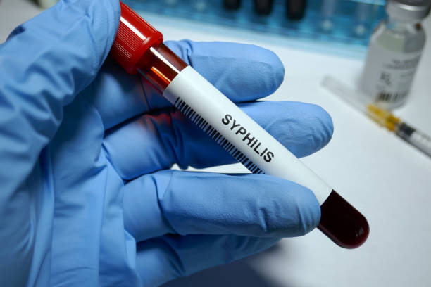 Understanding Syphilis and HIV