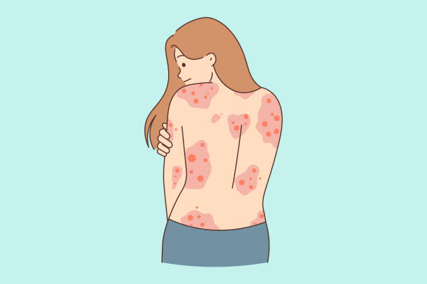 Psoriasis is a persistent autoimmune skin disorder.