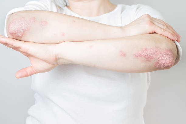 Understanding Psoriasis