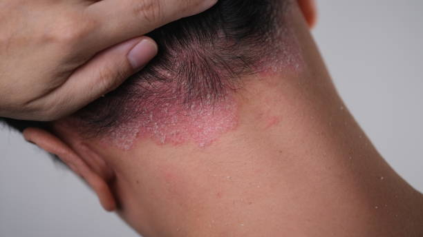 Diagnosis and Treatment Options for Scalp Psoriasis