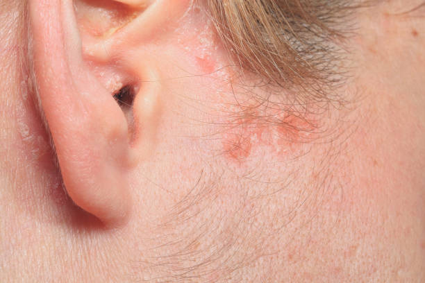 Prescription Medications for Scalp Psoriasis