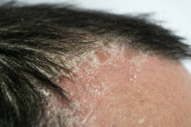 Tips for Preventing Scalp Psoriasis Flare-ups