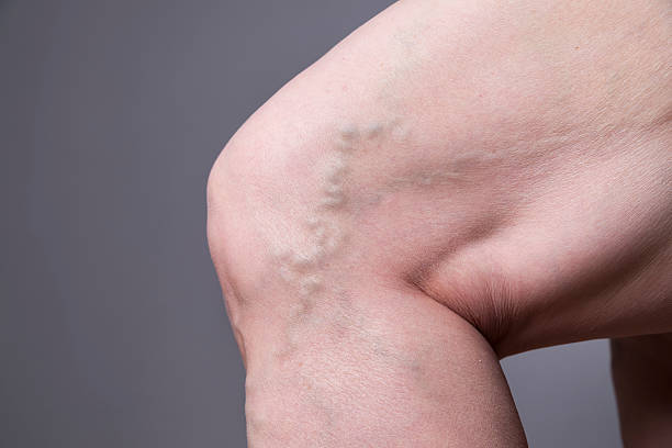 While varicose veins may be a cosmetic issue for some, they can also cause severe discomfort and impair quality of life for others.