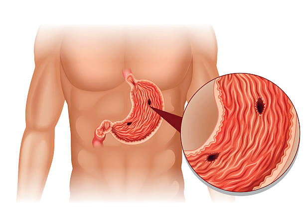 Complications from Ulcers