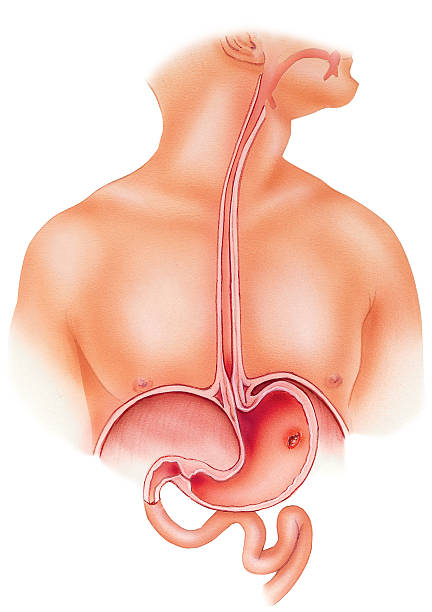 Symptoms of Ulcers