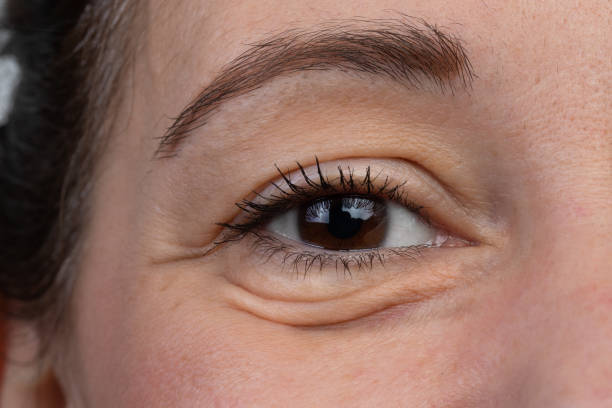 Causes of Under Eye Bags
