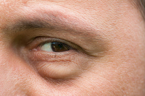 How Fillers Work for Under Eye Bags