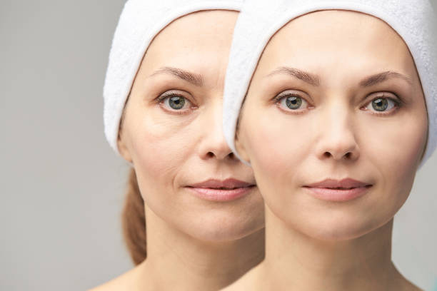 Alternatives to Fillers for Treating Under Eye Bags