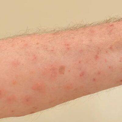 Understanding Contagious Skin Rashes