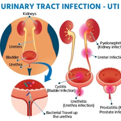What Really Happens if UTI Goes Untreated