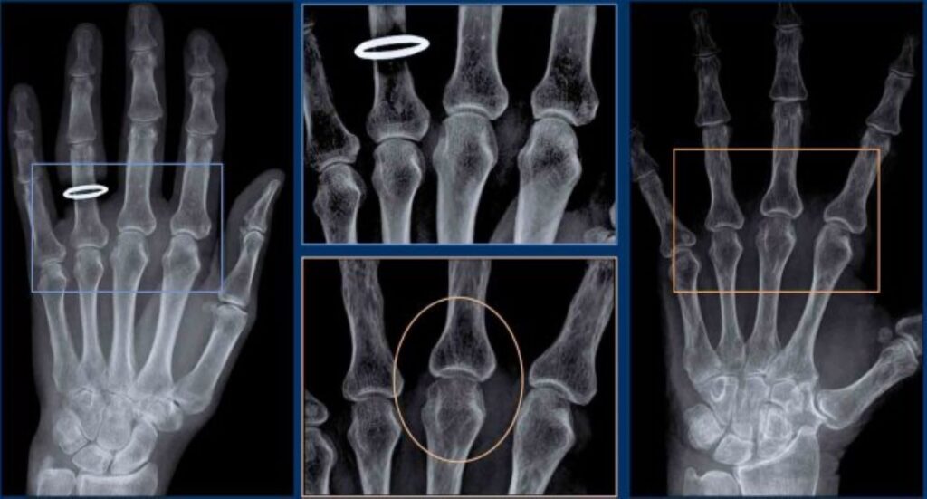 Can a Bone Density Test Reveal Arthritis?