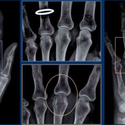 Can a Bone Density Test Reveal Arthritis?