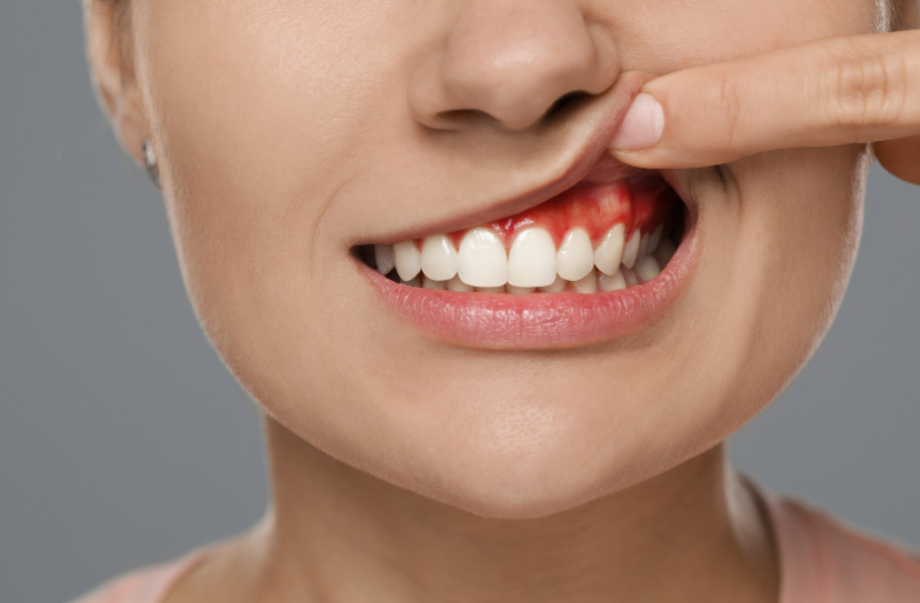 Discover the Deficiency Behind Bleeding Gums