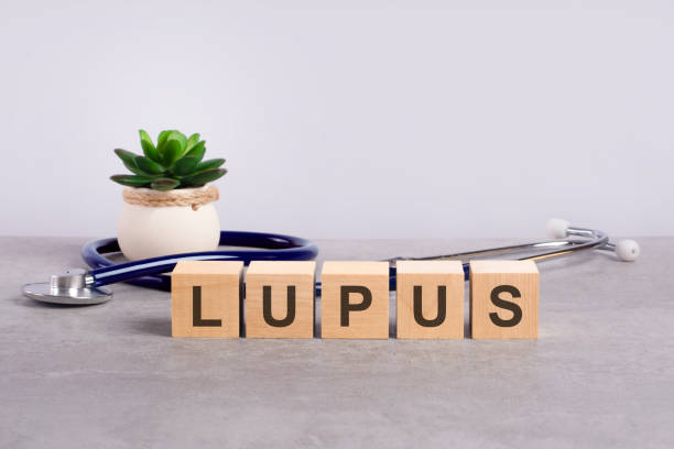 Symptoms of Lupus Affecting the Eyes