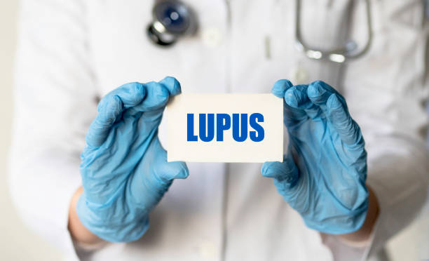 Tips for Managing Lupus Symptoms That Affect the Eyes