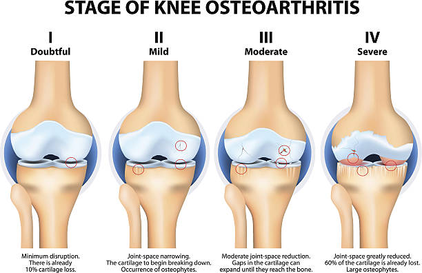 Stages of Knee Osteoarthritis