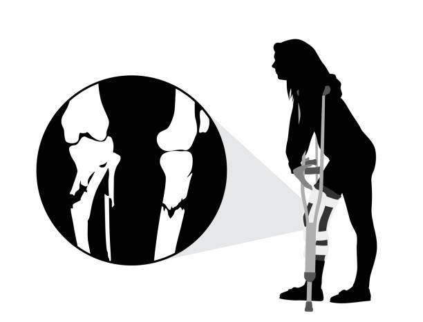 Understanding Osteoarthritis and Knee Braces