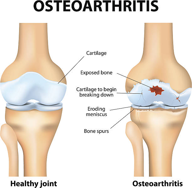 Factors to Consider When Choosing Exercises for Osteoarthritis