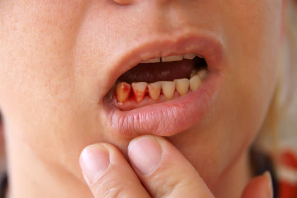 Vitamin C, commonly known as ascorbic acid, is required for the formation of collagen, a protein that strengthens the gums and connective tissues in your mouth.