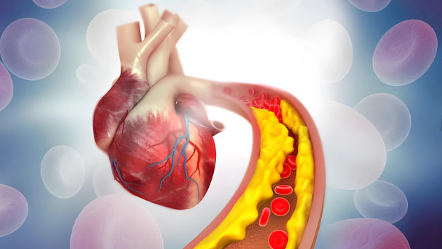 Atherosclerosis, caused by plaque formation in the arteries, restricts blood flow to the heart and brain, causing heart attacks and strokes