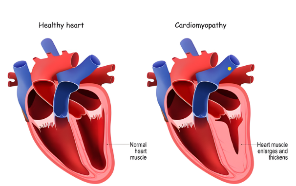 What Are Some of the Most Common Heart Health Issues? - Discovery Body