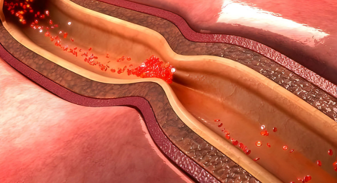 Coronary heart disease is a frequent phrase for the accumulation of plaque in the heart's arteries, which can result in a heart attack or an ischemic stroke. Which is one of the heart health issues