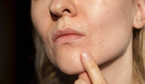 Signs and Symptoms of Vitamin Deficiencies