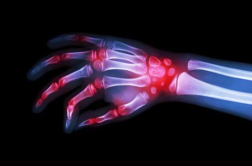 Rheumatoid arthritis can affect any joint in the body, although it typically affects smaller joints, particularly those in the hands, wrists, and feet. Signs and symptoms of the illness usually appear in waves.