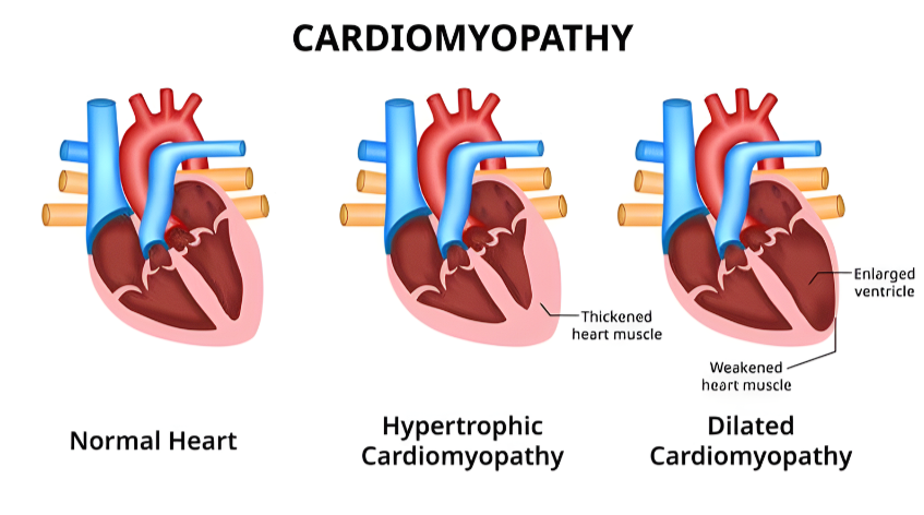 In cardiomyopathy, the heart muscle enlarges, thickens, or stiffens, affecting its capacity to adequately pump blood throughout the body.