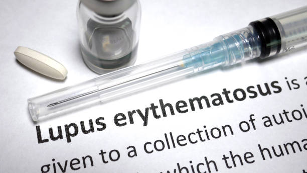 The autoimmune disease known as lupus is a chronic condition that affects millions of people all over the world.