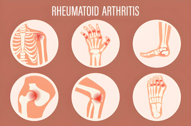 Rheumatoid arthritis (RA) can lead to various complications that affect different parts of the body. These complications may develop over time and vary in severity from person to person.
