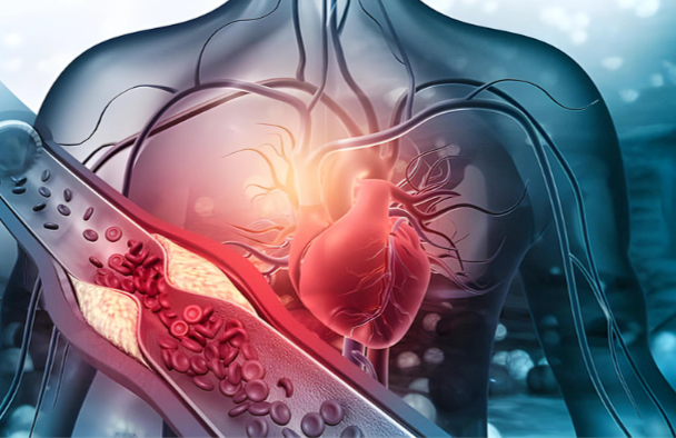 Rheumatoid arthritis (RA) is defined as a chronic inflammatory disorder that mostly affects joints.