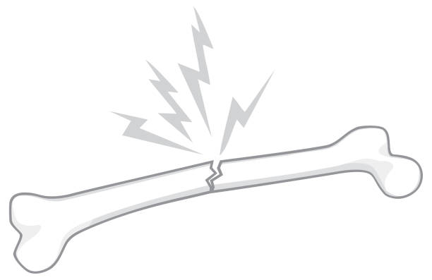Immediate Risks of Untreated Broken Bones