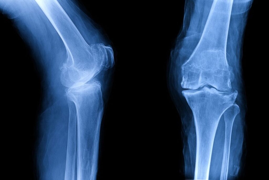 Embrace the Top Exercise for Osteoarthritis of the Knee