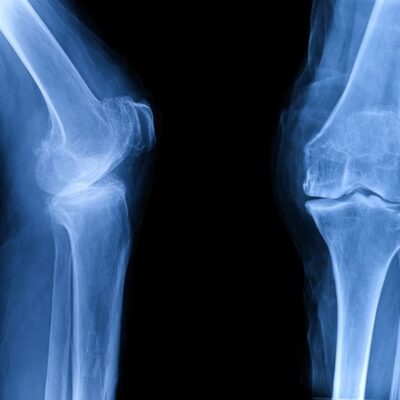 Embrace the Top Exercise for Osteoarthritis of the Knee