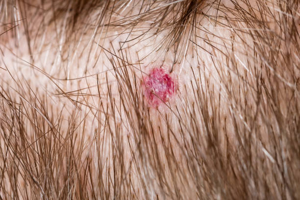 Detecting Skin Cancer on the Scalp - Discovery Body