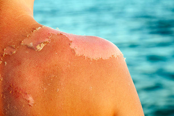 Understanding Skin Cancer and Sunburn