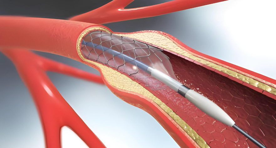 Carotid artery stenting (CAS) is a cutting-edge therapeutic option for carotid artery disease, giving a less invasive method than standard carotid endarterectomy