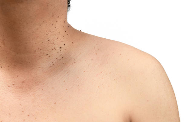 Skin tags are tiny, benign growths that hang from the skin