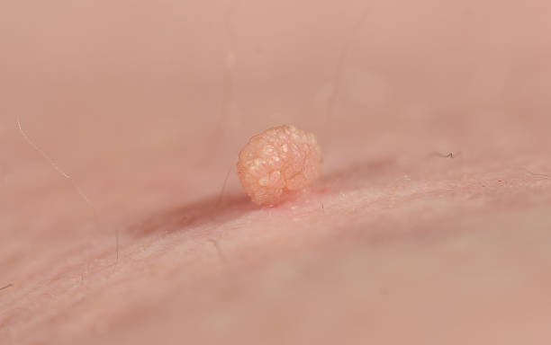 Skin tags, commonly referred to as acrochordons, are small, benign growths on the skin.