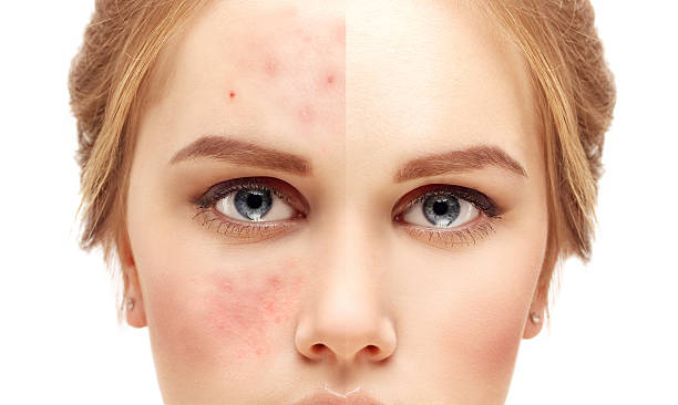 While skin tags are harmless and easily treated, they frequently grow back. Despite effective removal treatments such as freezing or cauterization, additional skin tags may develop over time, especially if there are predisposed factors such as obesity, genetics, or insufficient removal of the complete skin tag.