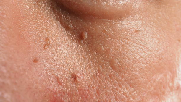 Understanding Skin Tags and Warts