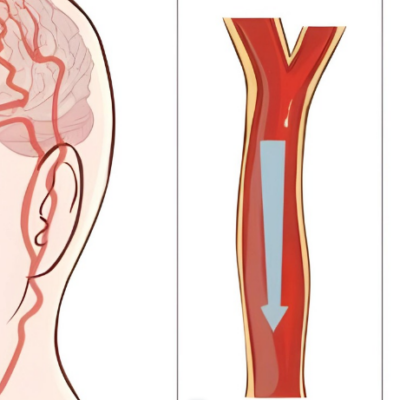 How to Prevent or Alleviate Blockage of Arteries in the Neck?
