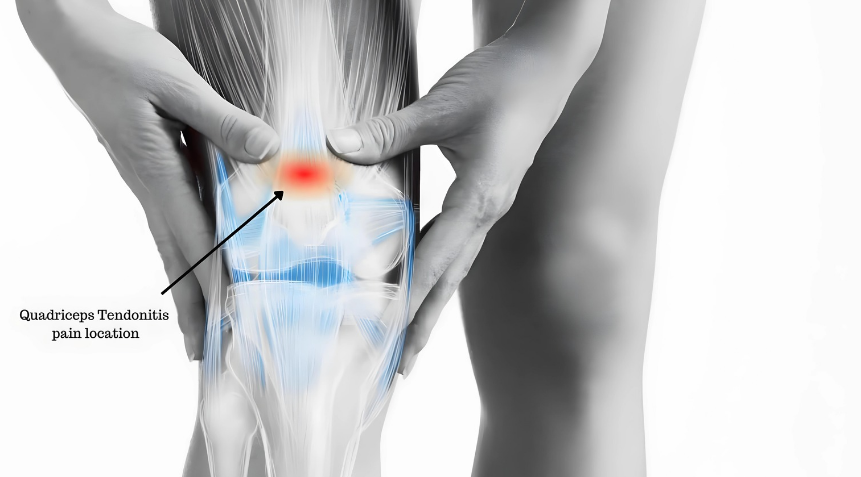 The quadriceps tendon connects your quadriceps muscles to your kneecap