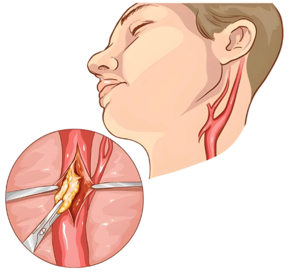 Treatment options for blocked neck arteries, also known as carotid artery disease, aim to reduce the risk of stroke and improve blood flow to the brain.