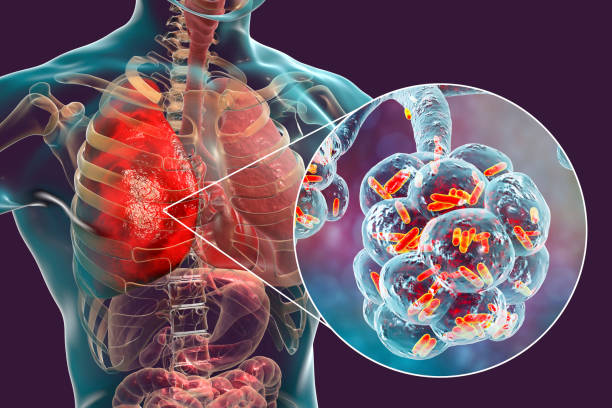 The disease is very contagious and quickly passed from person to person, particularly in crowded environments like schools and daycare centers.