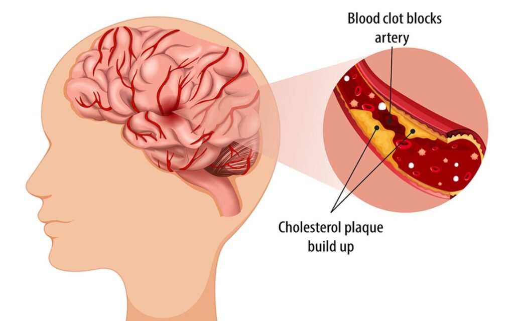 Discover How to Safeguard Yourself Against Strokes